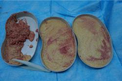 奥美定取出后的常见症状及潜在并发症解析