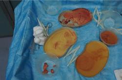 奥美定取出后立即填硅胶假体的风险和费用解析