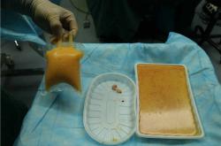 奥美定取出费用及危害分析，选择正规医院最重要