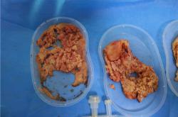 全面解析：奥美定取出手术的过程、风险与费用