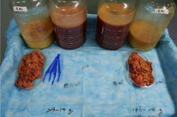 「奥美定取出术后潜在并发症及费用详解」