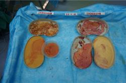 奥美定取出手术哪里安全靠谱？费用风险及并发症解析