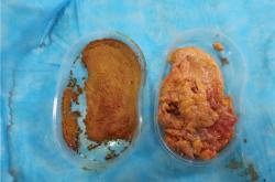 选择最佳奥美定取出医生：专家建议、风险评估与费用分析