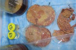 奥美定取出手术：了解症状、危害及费用风险