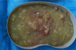 奥美定取出后乳房塌陷：症状识别及修复方案解析