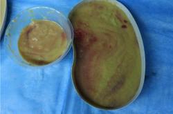 奥美定取出费用及潜在危害详细解析