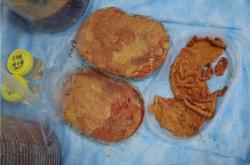 微创奥美定取出手术：症状、危害与费用详解