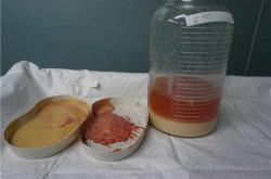 美丽的代价？丰体针丰胸手术后常见健康隐患