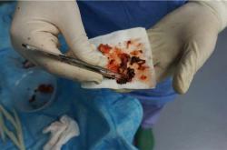 丰体针丰胸手术中的常见感染症状及预防方法