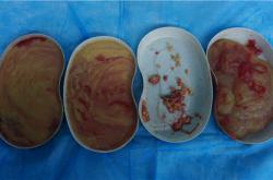 英捷尔法勒注射20年后是否需要取出乳房填充物？