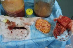 注射隆胸后的取出方法及注意事项解析