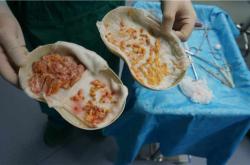 选择理想医院进行奥美定取出手术的指南