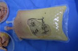 丰体针丰胸后的麻醉过敏症状有哪些及如何处理