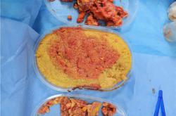 奥美定风险分析：取出与不取出的危害对比详解