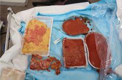 选择哪家医院进行英捷尔法勒凝胶隆胸取出手术更安全？