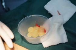 15年前注射隆胸：取出手术的风险与挑战