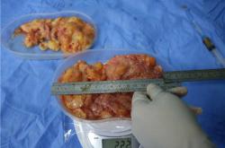 全面解析英捷尔法勒隆胸取出手术的费用及考量因素