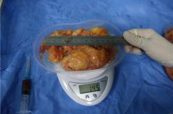 注射隆胸物取出术需要挂哪个科室就诊解析