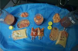 解析奥美定取出费用及相关影响因素