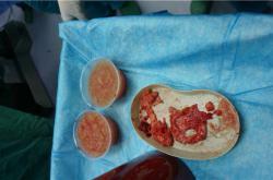 奥美定取出后需等待多长时间才能恢复自慰？