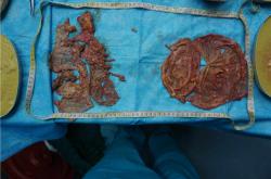 奥美定取出手术：解析最佳方法与注意事项