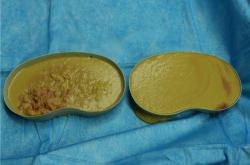 英捷尔法勒隆胸取出后恢复周期与护理指南