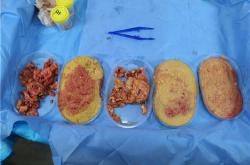 71岁母亲丰胸手术取残留物：专家解答常见疑虑