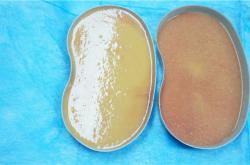 “揭示奥美定整形后遗症：风险与恢复全解析”