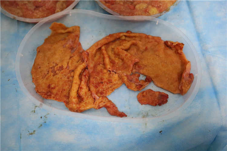 丰体针丰胸后的自我检测：从症状识别潜在问题