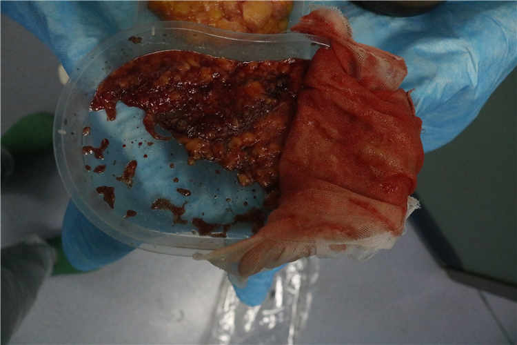 如何识别丰体针丰胸后的过敏症状及应对方法