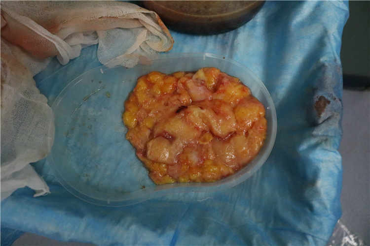 手术或成灾难？丰体针丰胸后的潜在健康危机