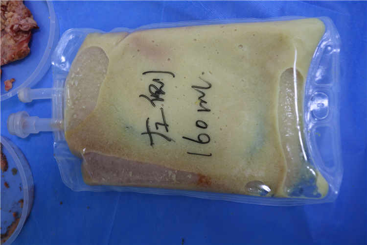 奥美定取出手术对乳房健康的潜在影响与风险分析