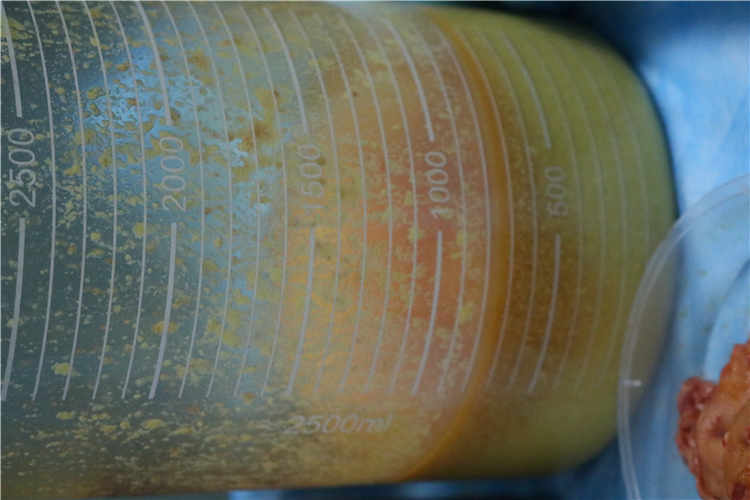 探讨乳房填充物取出术的潜在风险与安全性