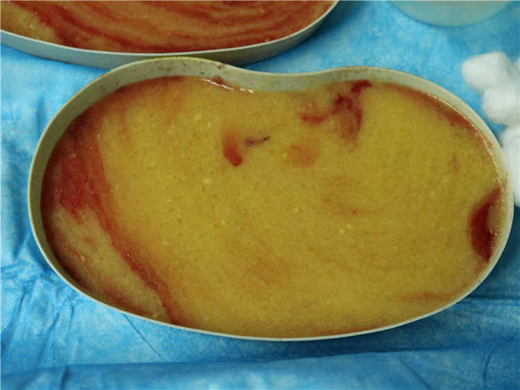 丰体针丰胸后的乳房外形异常及如何科学修复