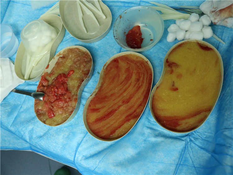 奥美定取出术后40天：胸部刺痛感是否属于康复正常现象？