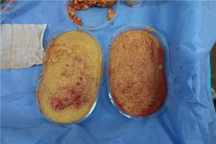 在成都哪里可以安全取出奥美定?医疗机构推荐与注意事项 在成都哪里可以安全取出奥美定?医疗机构推荐与注意事项