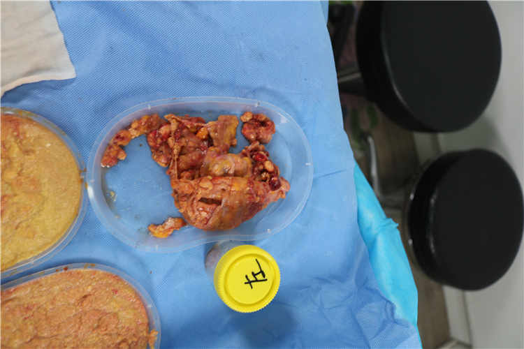 权威医院推荐:奥美定隆胸取出最佳选择 权威医院推荐:奥美定隆胸取出最佳选择