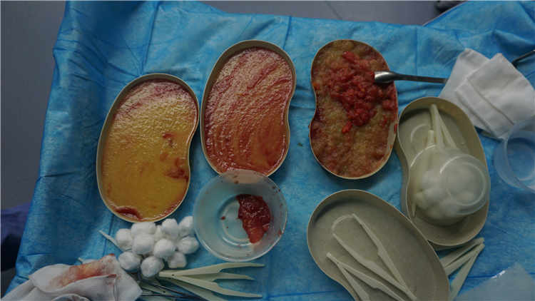 如何识别丰体针丰胸后的过敏症状及应对方法