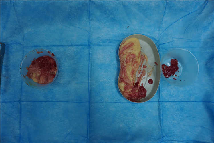 奥美定取出手术对乳房健康的潜在影响与风险分析