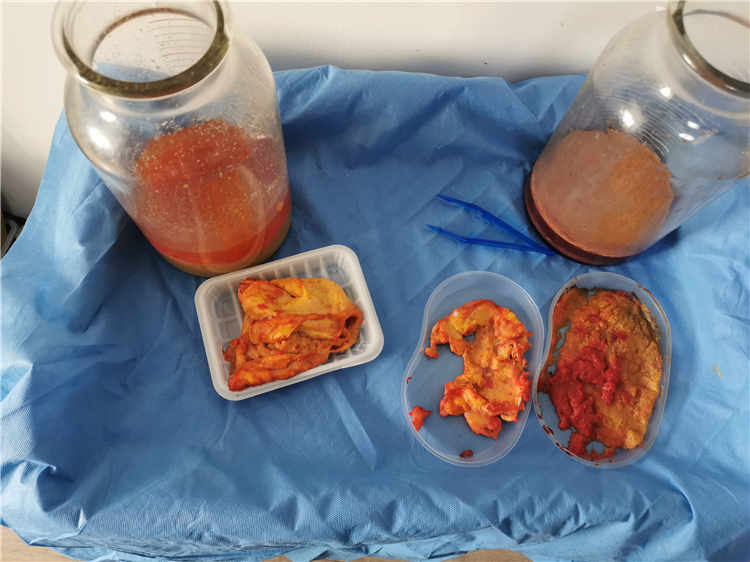 揭秘：如何评估20年前注射的丰胸奥美定取出量？