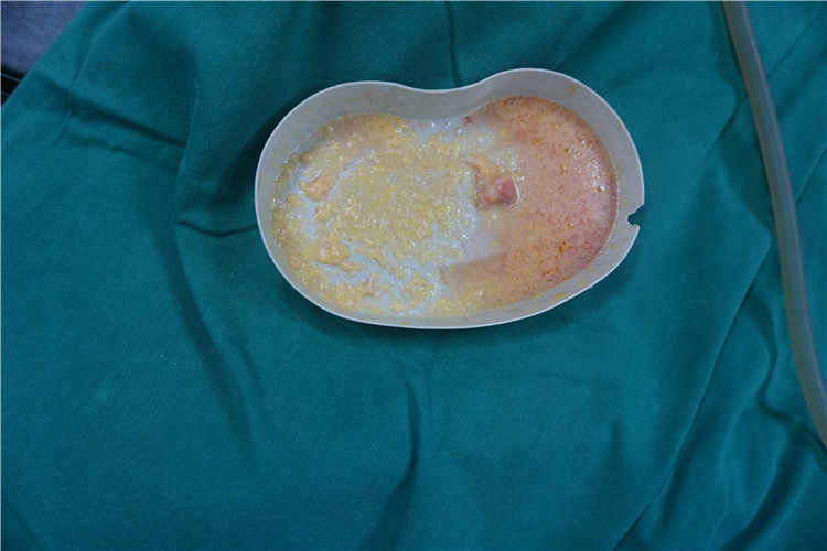 探讨乳房填充物取出术的潜在风险与安全性