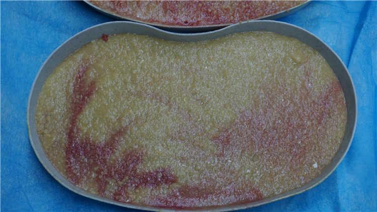 揭开奥美定取出最佳方案的秘密 揭开奥美定取出最佳方案的秘密