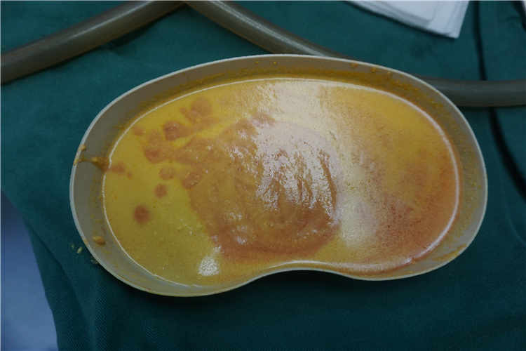 奥美定取出手术费用解析及影响因素 奥美定取出手术费用解析及影响因素