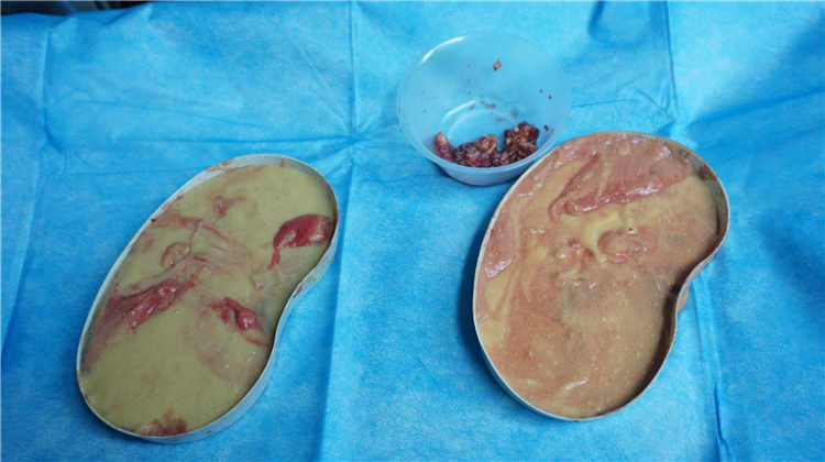 历经20年，上海哪家医院最擅长取出英捷尔法勒注射隆胸？