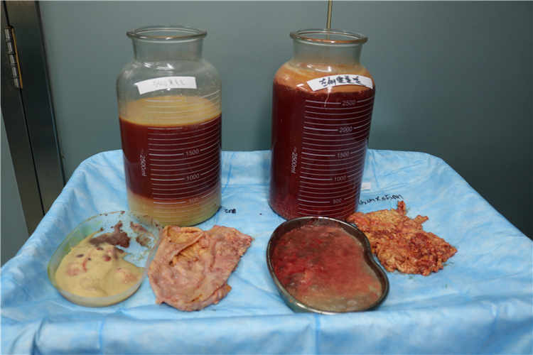 丰体针丰胸是否值得？风险与效果的全面比较