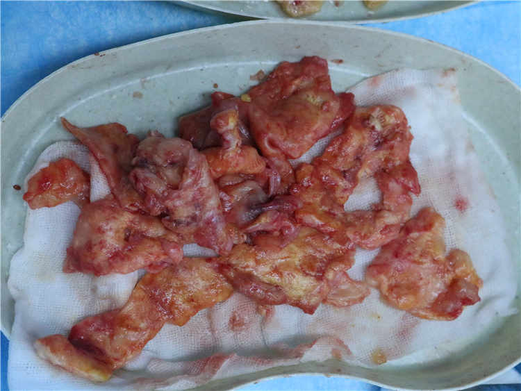 奥美定取出手术费用解析及影响因素 奥美定取出手术费用解析及影响因素