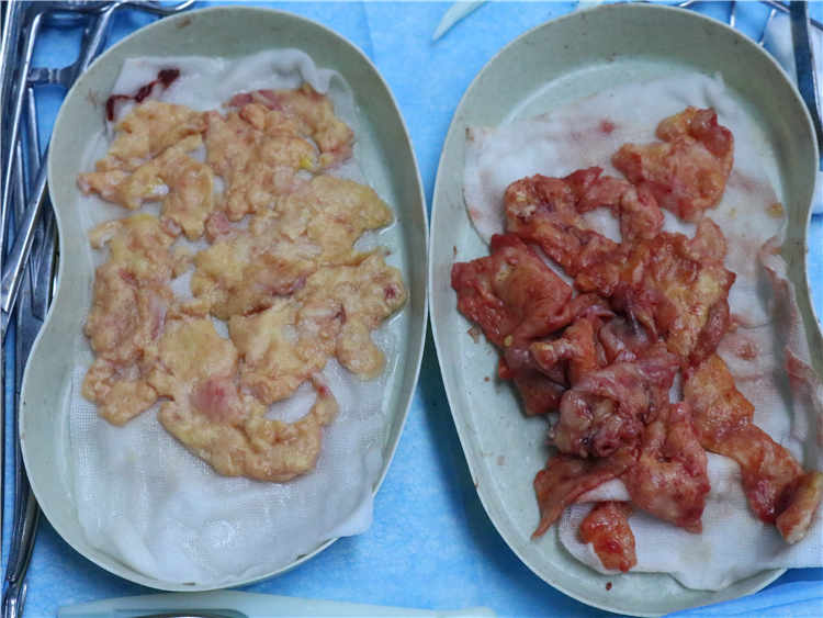 揭秘：如何评估20年前注射的丰胸奥美定取出量？