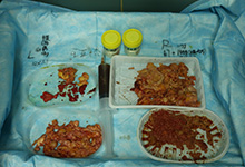 奥美定取出危害及费用分析：选择专业医院更放心