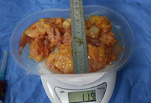 谁说奥美定少量根本不用取出？我来告诉你奥美定不取出来会怎样？