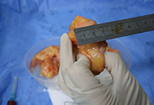 取奥美定手术多少钱？